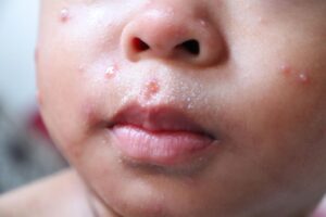 Campak pada Anak: Gejala, Penyebab, Penularan, dan Cara Mencegahnya